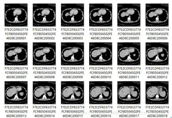 MicroDicom  viewer(Dicom格式看图软件)